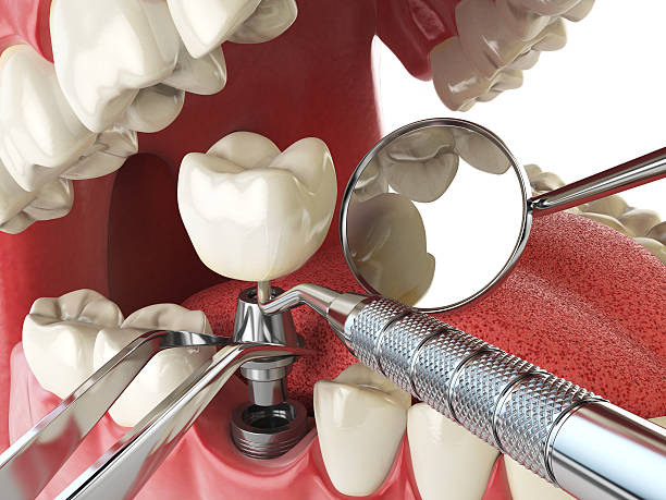 Best Lost Filling or Crown Replacement in Waverly, IA